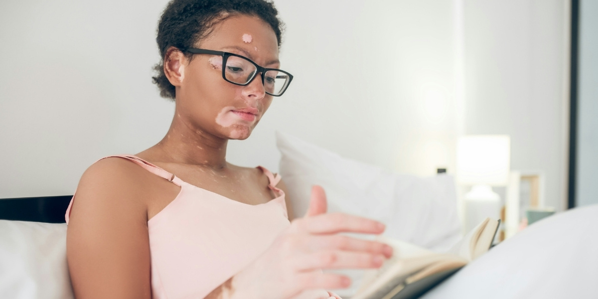 Holistic Approaches to Managing Vitiligo Effectively